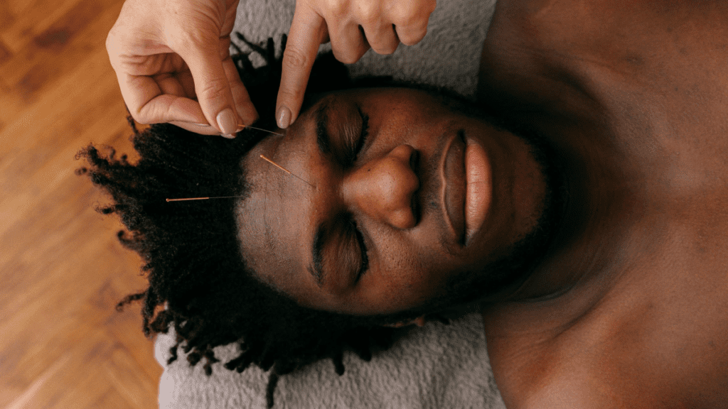 Acupuntura facial_4 | Treatwell