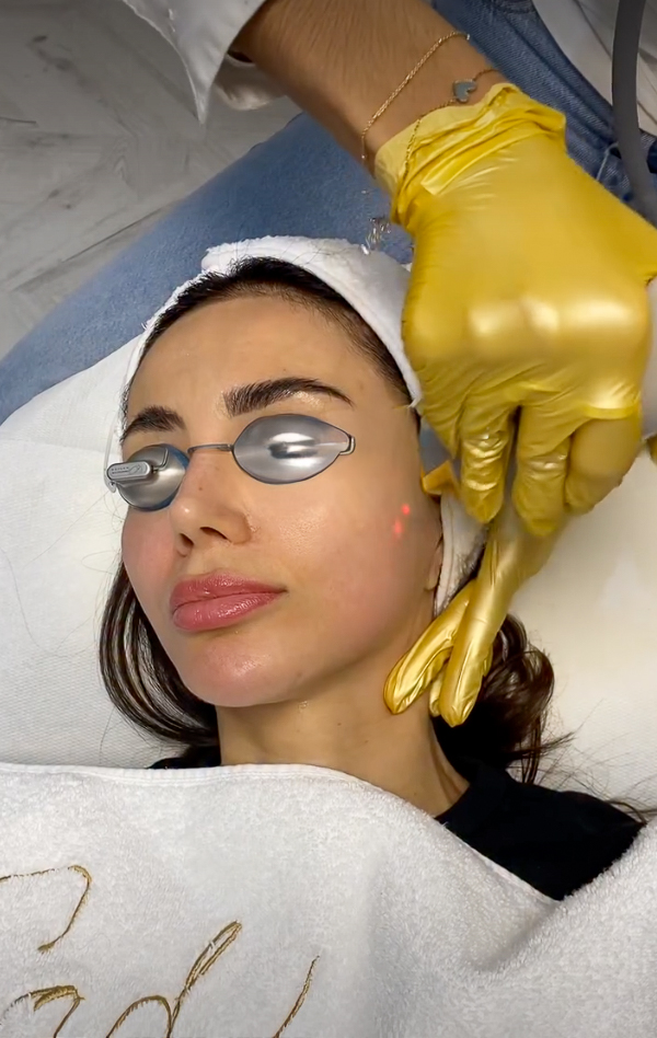 Fotorrejuvenescimento (IPL), IG @sadaf_jaffari | Treatwell