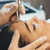 Plano aproximado de um tratamento profissional de microneedling no rosto de uma mulher numa clínica