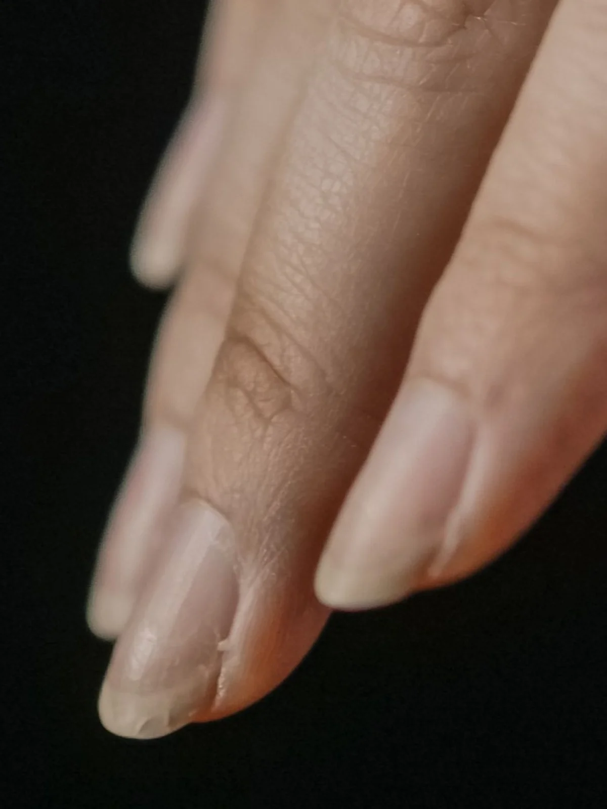 Grande plano de algumas unhas com descamação no bordo livre